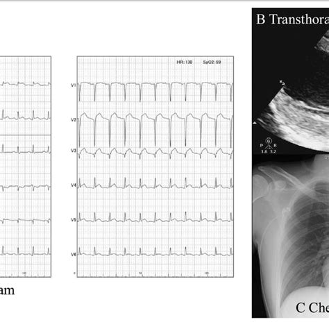 Electrocardiographic Transthoracic Echocardiogram And Chest