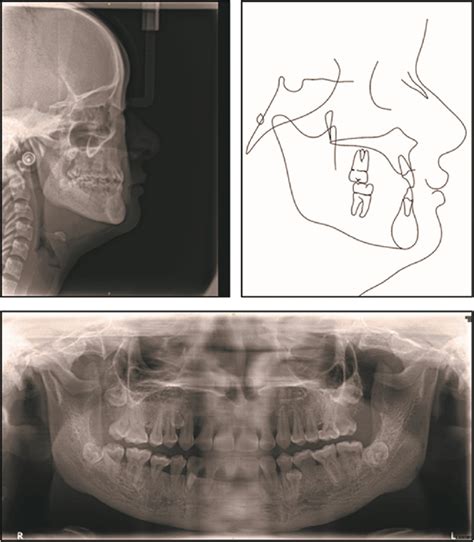 Post Treatment Panoramic Radiograph Lateral Radiograph And