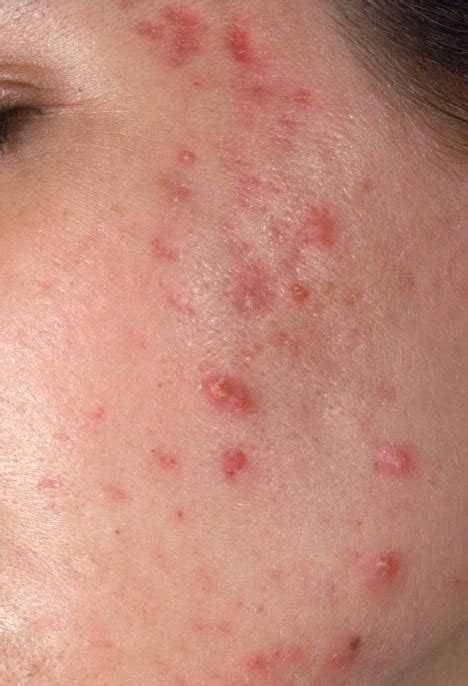 Acne Pustular Icd L Online Consultation Ai Dermatologist