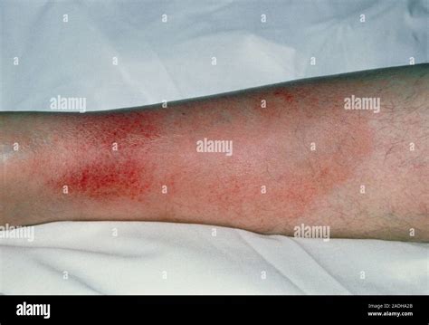 Cellulitis View Of Swelling And Inflammation On The Lower Leg Due To