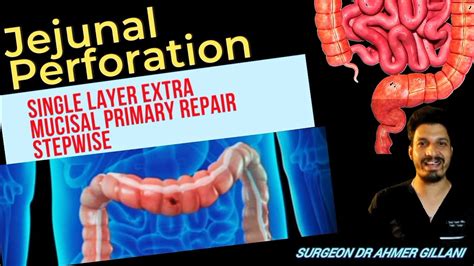 Primary Anastomosis Of Jejunal Perforation In 2 Years Childexploratory