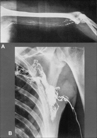 Axillary Web Syndrome After Axillary Dissection The American Journal