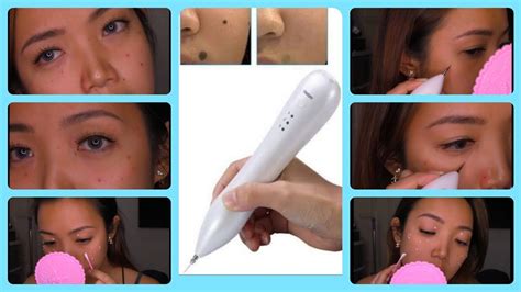 Mole Removal Pen Best For Warts And Skin Tags OMG YouTube