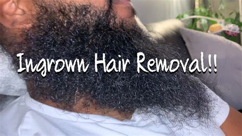 How To Get Rid Of Ingrown Hair Bumps On Beard At Kevin Acosta Blog