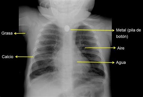 Continuum Radiograf A De T Rax Indicaciones Diagn Stico Y Casos