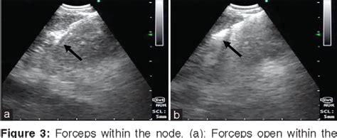 Figure 3 From Endobronchial Ultrasound Guided Intranodal Forceps Biopsy