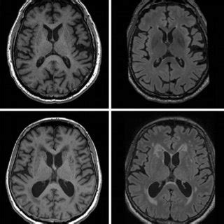 Study’s flowchart. PD Parkinson’s disease, VP vascular parkinsonism ...