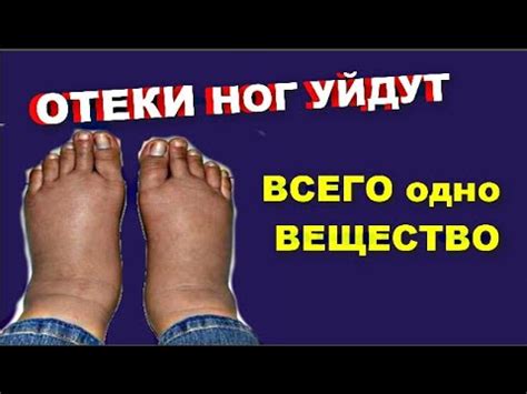 ОТЕКИ уйдут , добавь ОДНО ВЕЩЕСТВО . - YouTube