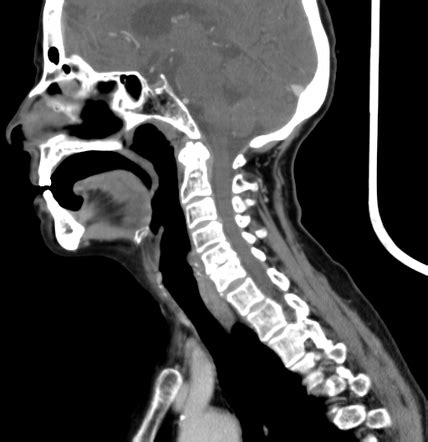 Submandibular Sialolithiasis And Chronic Sialadenitis Image