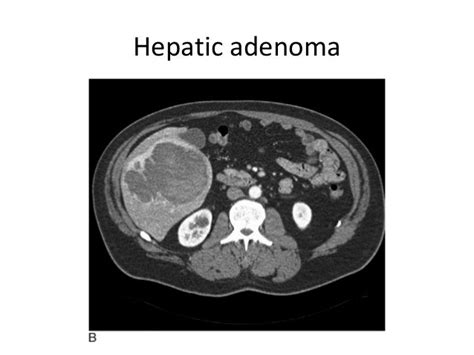 Benign liver masses