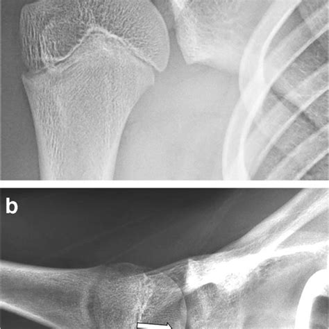 Normal Development Imaging Pitfalls And Injuries In The Pediatric Shoulder Request Pdf