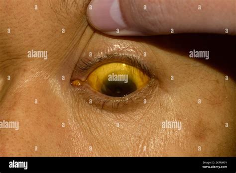 Deep Jaundice In Asian Male Patient Yellowish Discoloration Of Skin