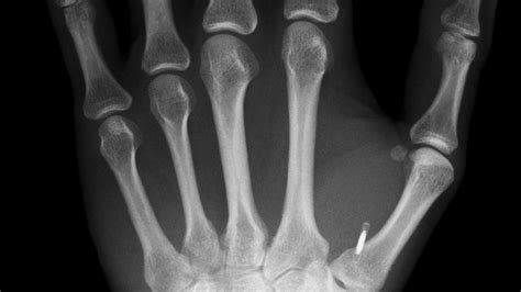 The Surprising Truths And Myths About Microchip Implants Bbc Worklife