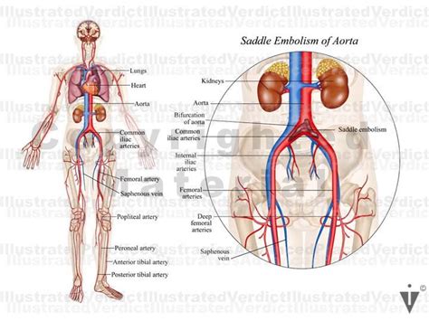 Iliac Artery Leg