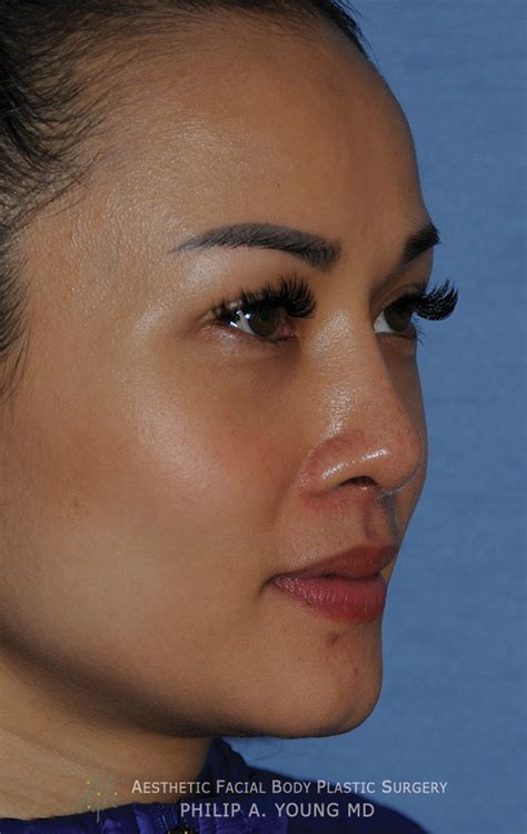 Asian Rhinoplasty Before And After Photos Seattle Bellevue