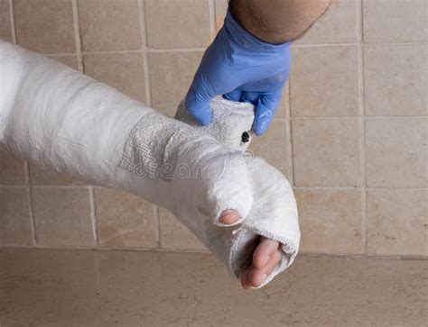 Orthopedic Technician Putting On A Fiberglass Plaster Cast Stock Image