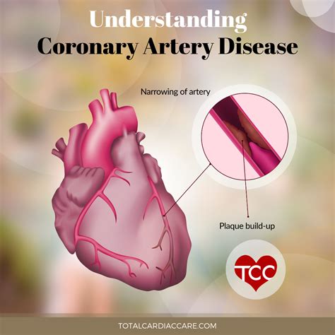 Understanding Coronary Artery Disease Cad Total Cardiac Care