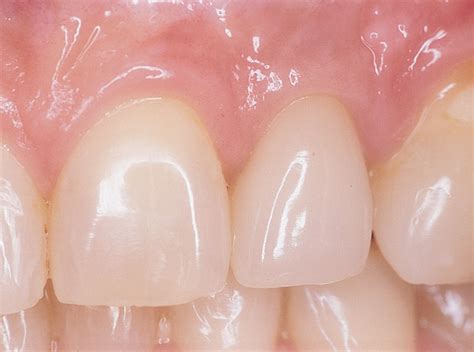 10 Soft Tissue Manipulation Around Implants In The Esthetic Zone Pocket Dentistry