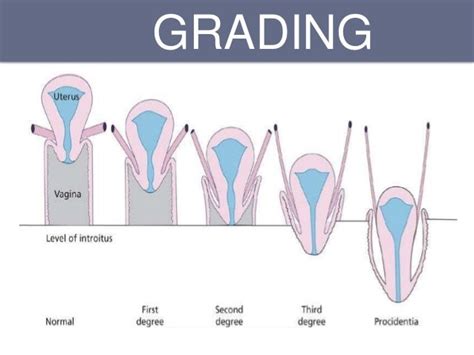 Stage 2 Pelvic Organ Prolapse