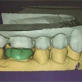 Endocrown preparation. | Download Scientific Diagram