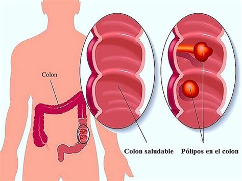 Polipos en el Colon Doctor Luis Javier Cárdenas