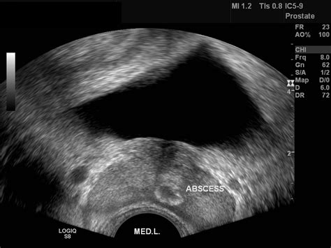 Prostatic Abscess Trus Image Radiopaedia Org