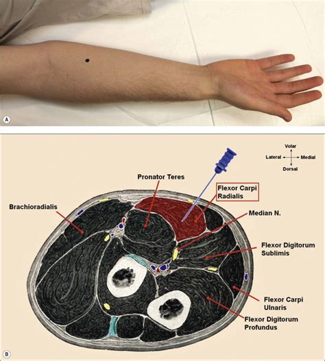 Anatomy for Needle Electromyography | Musculoskeletal Key