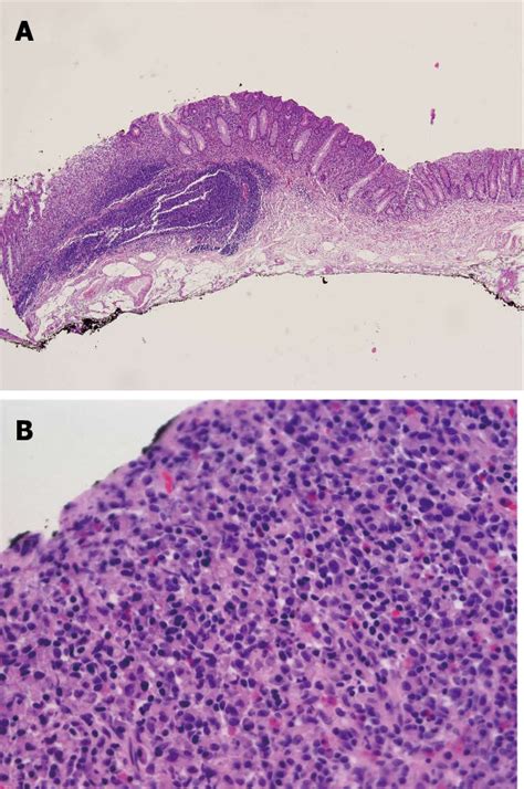 Figure 1 From Early Stage Primary Signet Ring Cell Carcinoma Of The Colon Semantic Scholar