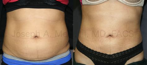 Stomach Liposuction Before And After Women