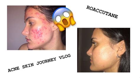 Getting Rid Of My Acne My Experience With Roaccutane Acne Skin