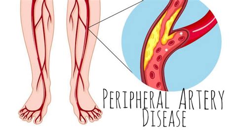 Peripheral Arterial Disease Pad Youtube