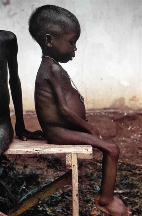 File:Starved girl.jpg - Wikipedia, the free encyclopedia