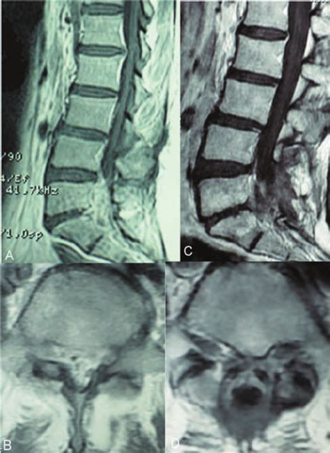 A Sagittal T1 Weighted Mr Images With Contrast Demonstrated Marked