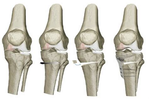 Traitement Chirurgical De L Arthrose Clinique Du Genou Paris Dr