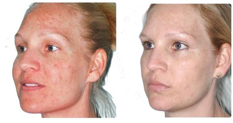 Photofacial And Light Chemical Peel Edited Cover Ageless In The Triad Med Spa