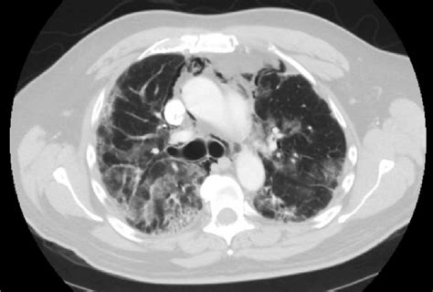 -Pneumomediastinum in a severe case of COVID-19 infection | Download Scientific Diagram