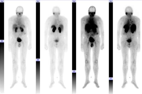 Patient Whole Body Scan Min Post First Lu Psma Application