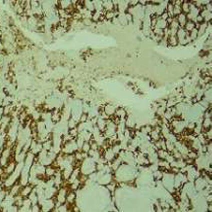 H E Showing Tumor Cells In Zell Ballen Pattern Surrounded By Delicate