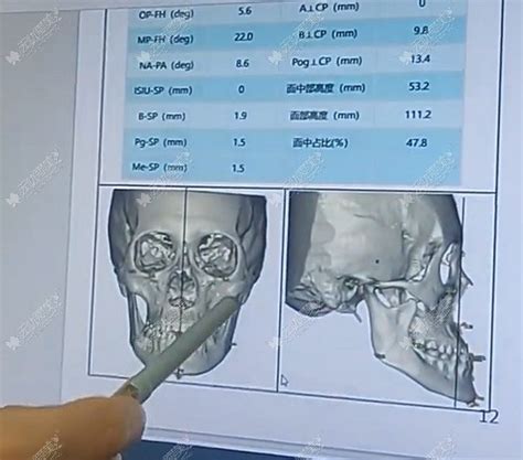 广州艾伟健做正颌手术好吗他的骨性地包天矫正实例勿错过 面部整形 无忧爱美网