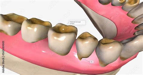 Dental erosion, also known as tooth erosion Stock Illustration | Adobe ...