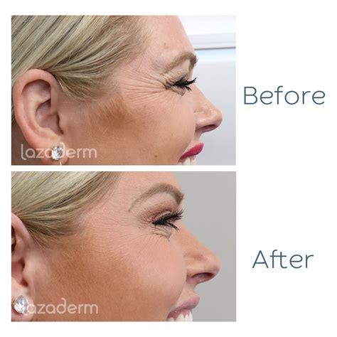 Botox Before And After Photos Lazaderm Laser Aesthetics