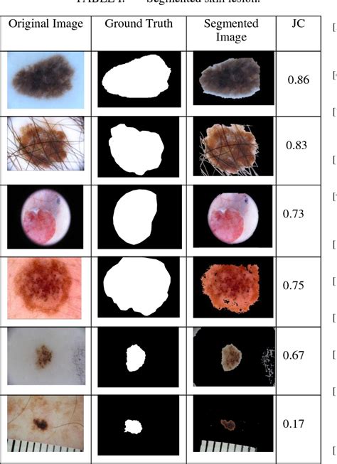 Table I From Automatic Skin Lesion Segmentation Using GrabCut In HSV