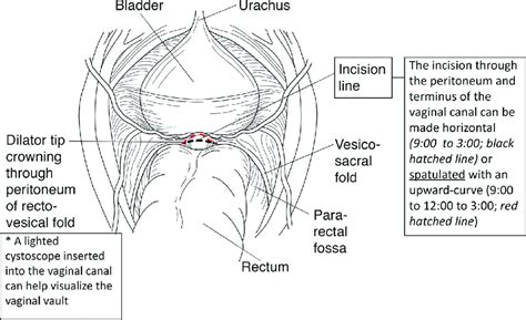 Incision And Spatulation Of Remnant Vaginal Canal End A Midline