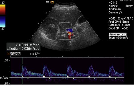 Proximal Renal Artery Ultrasound
