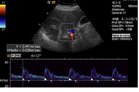 Renal Artery Doppler Ultrasound