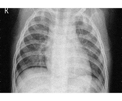 Classification Of Pediatric Pneumonia Using Chest X Rays By Functional