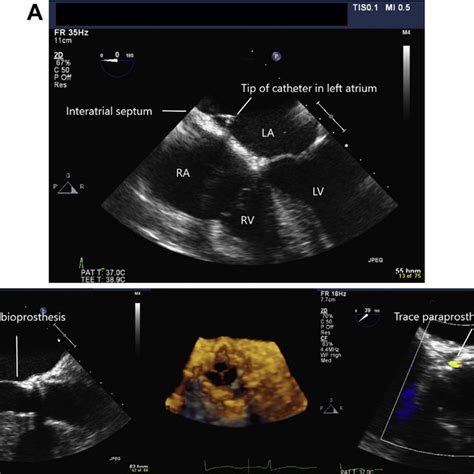 A Echocardiography Guided Transseptal Puncture The Catheter Crossing