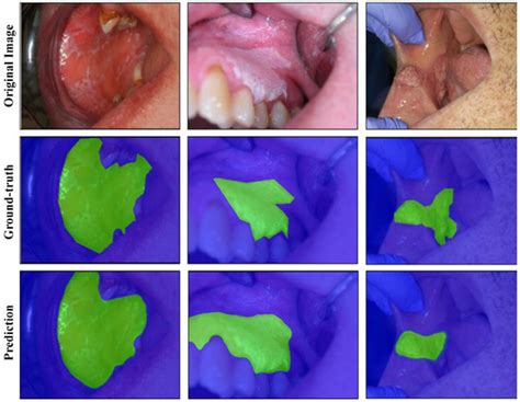 Cancers Free Full Text Automated Detection And Classification Of Oral Lesions Using Deep