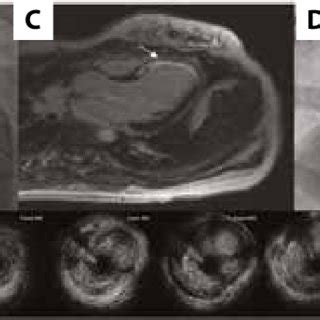 A Anteroposterior Cranial View Of LCA Acute Occlusion Of LAD Artery