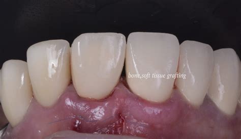 Tooth 11 Minimal Invasive Extraction And Restoration With P5D Dental